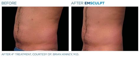 17 Emsculpt Temecula Providers .